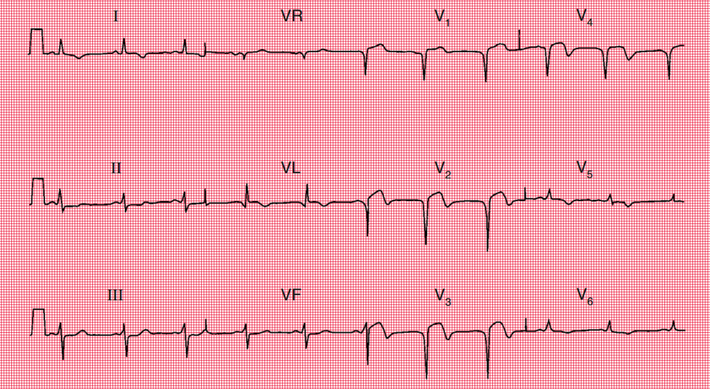 Electrocardiograma del paciente que muestra elevación del segmento ST en derivaciones V2, V3 y V4, compatible con infarto agudo de miocardio anterior