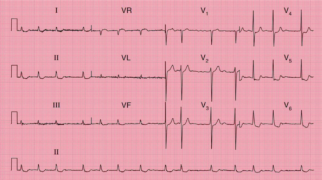 Electrocardiograma que muestra signos clásicos de intoxicación por digoxina en una paciente con fibrilación auricular crónica. Se observan depresión del segmento ST en forma de "cuenco", característico de los efectos digitales, y un ritmo irregular típico de la fibrilación auricular.