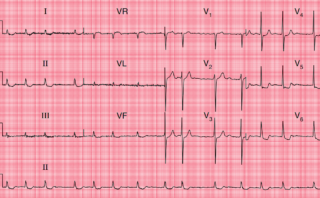 Infarto Agudo de Miocardio de Cara Anterior | CASO CLÍNICO