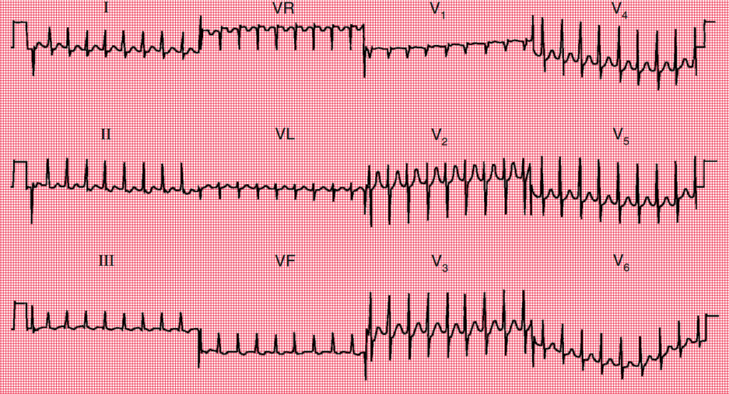 Electrocardiograma mostrando taquicardia de la unión, con una frecuencia cardíaca rápida 200 LPM, complejos QRS estrechos y un ritmo regular. Las ondas P no son visibles antes de los complejos QRS, lo que sugiere un origen de la unión AV.