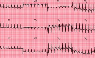 Angina Inestable | CASO CLÍNICO