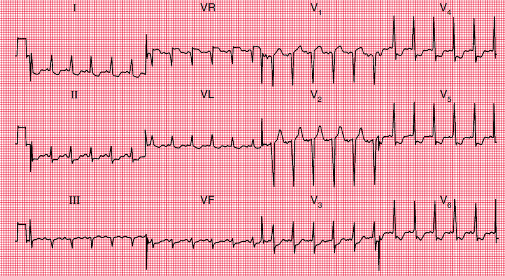 Electrocardiograma mostrando depresión del segmento ST e inversión de la onda T, lo cual indica isquemia miocárdica subendocárdica sin evidencia de necrosis.