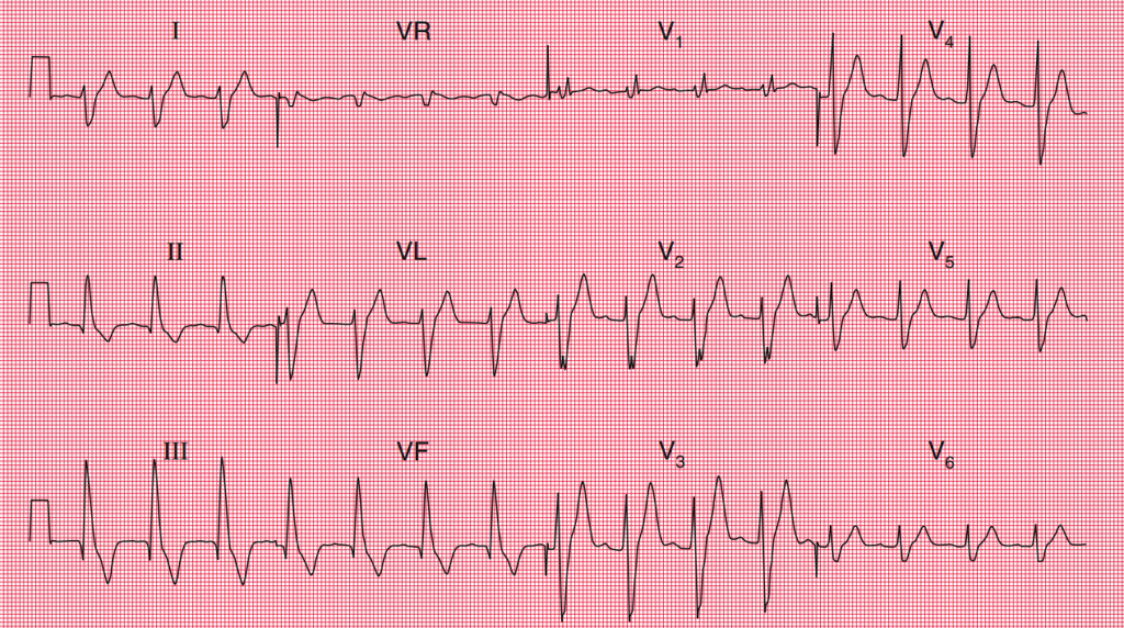 Electrocardiograma con ritmo sinusal, mostrando un bloqueo completo de rama derecha, desviación del eje a la derecha y bloqueo fascicular posterior. El QRS ancho y el patrón de RsR' en V1 y V2 son característicos de este tipo de bloqueo.