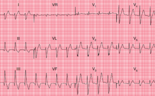 Angina Inestable | CASO CLÍNICO