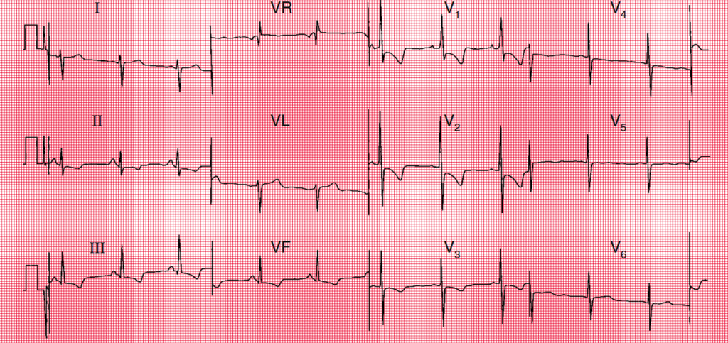 Electrocardiograma de 12 derivaciones que muestra ritmo sinusal con ondas P picudas, desviación del eje a la derecha, ondas R dominantes en V1, ondas S profundas en V6 y ondas T invertidas en II, III, aVF y V1-V3, consistente con hipertrofia ventricular derecha.