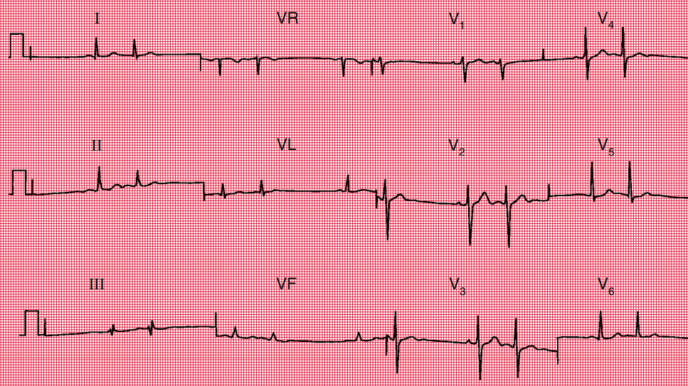 Electrocardiograma mostrando extrasístoles auriculares, identificables por la aparición de latidos prematuros con ondas P de morfología anómala y pausas compensatorias incompletas.