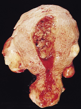 Sección de útero con carcinoma endometrial en examen macroscópico. Se observa una masa tumoral que ocupa la cavidad endometrial, con extensión a la superficie del endometrio y presencia de áreas necróticas y hemorrágicas. Esta imagen representa la apariencia típica de un adenocarcinoma endometrial, destacando la invasión del tumor en la capa interna del útero.