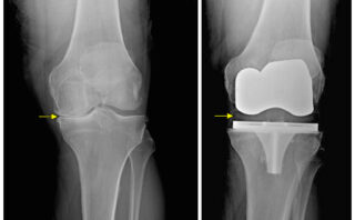 Artroplastia de Cadera | Procedimiento y Complicaciones Postoperatorias