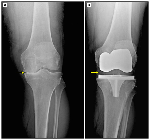 Radiografías preoperatoria (A) y postoperatoria (B) de una rodilla sometida a artroplastia total. La prótesis restaura el espacio articular y mejora la funcionalidad en una rodilla afectada por osteoartritis severa.