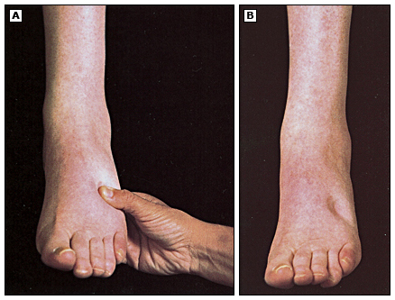 Evaluación del edema depresible (signo de Godet) en el tobillo. (A) Presión digital sobre el área edematosa del tobillo. (B) Persistencia de la depresión en la piel después de retirar la presión, característico del edema con fóvea