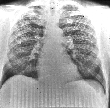 La radiografía de tórax muestra múltiples nódulos de 3 a 5 mm de diámetro, con sesgo hacia los lóbulos superiores. Nótese la calcificación en algunos de los nódulos pulmonares y en los ganglios linfáticos hiliares.