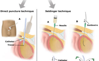 Toracocentesis: Técnica, Indicaciones y Consideraciones Clínicas