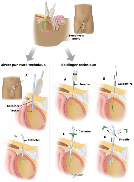 Técnicas de Inserción de Catéter Suprapúbico