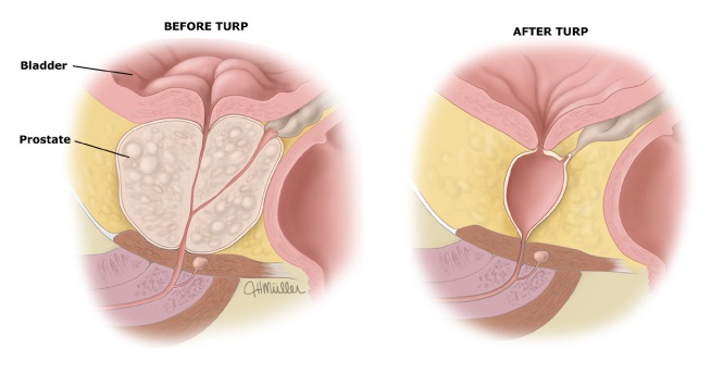 Comparación de la anatomía de la próstata y la vejiga antes y después de la resección transuretral de próstata (RTU-P).