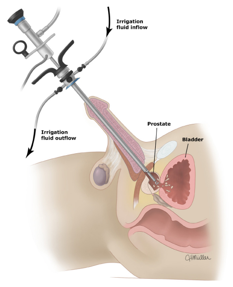 Ilustración del procedimiento de resección transuretral de próstata (RTU-P). Se muestra la inserción del resectoscopio a través de la uretra, alcanzando la próstata.