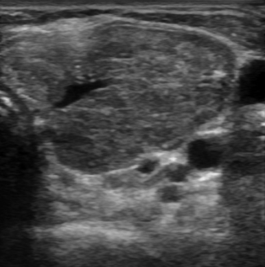 Se observa una glándula de contornos irregulares, con ecogenicidad heterogénea y disminuida, lo cual es característico en la enfermedad de Graves