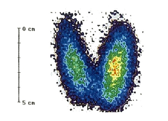 Gammagrafía tiroidea con captación homogénea y aumentada en ambos lóbulos, patrón característico de la enfermedad de Graves.