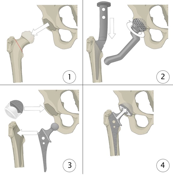 Ilustración de los pasos en una artroplastia total de cadera, desde la resección femoral hasta el ensamblaje final de los componentes protésicos.