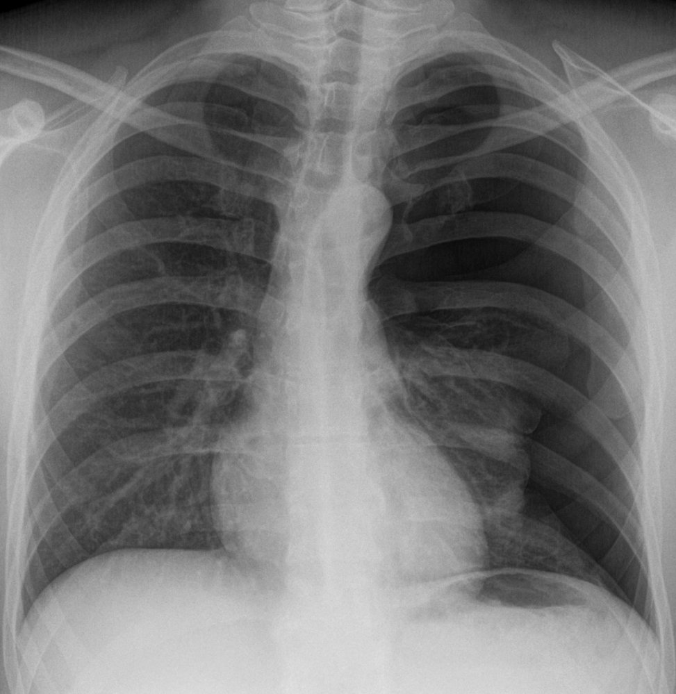 La imagen es una radiografía de tórax en vista posteroanterior (PA). En ella se observa la estructura ósea de las costillas, la columna vertebral y la clavícula. También se puede ver el contorno de los pulmones y el mediastino central.