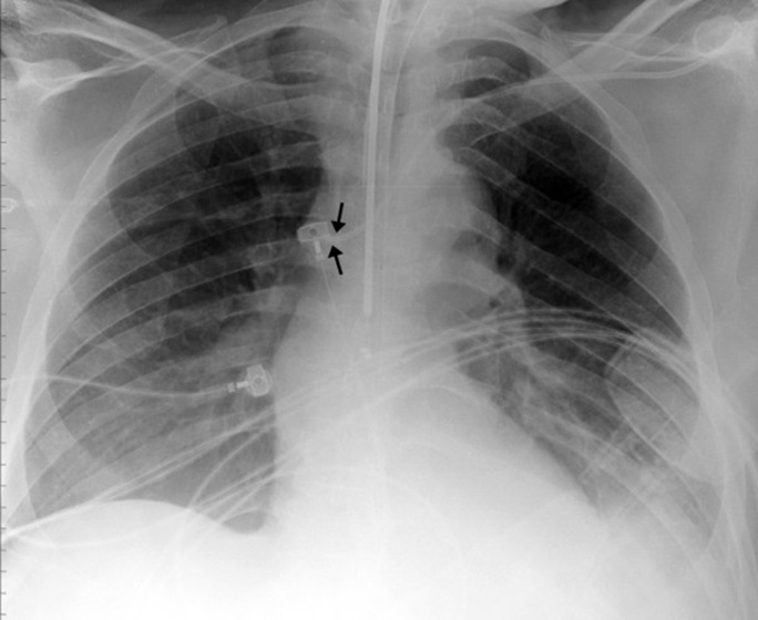 Radiografía de tórax que muestra la colocación de un catéter venoso central. Las flechas indican la posición de la punta del catéter en la vena cava superior