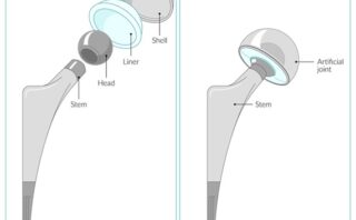 Artroplastia de Rodilla | Indicaciones, Técnicas y Manejo Postoperatorio