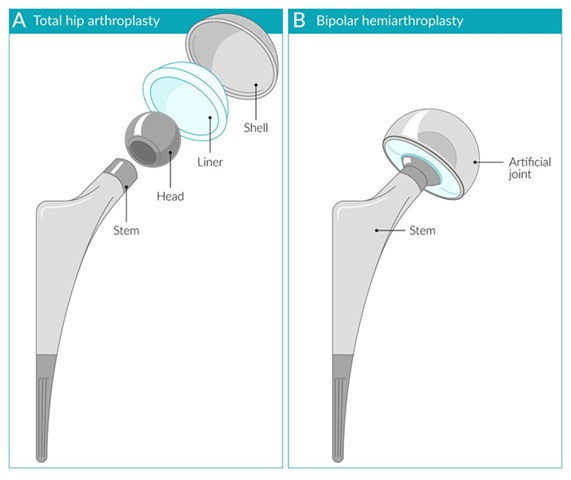 Comparación entre artroplastia total de cadera (A) y hemiartroplastia bipolar (B), mostrando los diferentes componentes de cada prótesis y su configuración en el reemplazo articular.