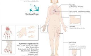 Mononucleosis Infecciosa | CASO CLÍNICO