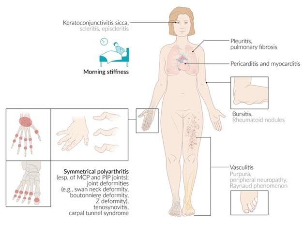 Manifestaciones clínicas de la artritis reumatoide: incluye afectación articular simétrica, rigidez matutina, complicaciones sistémicas (pulmonares, cardíacas, cutáneas) y deformidades características como el cuello de cisne y boutonniere.