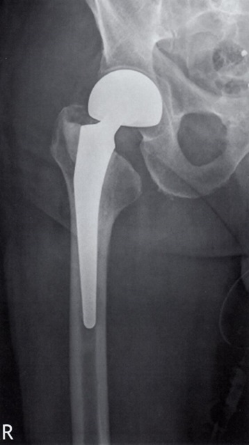 Radiografía de cadera derecha con prótesis total de cadera mostrando el componente femoral y acetabular.