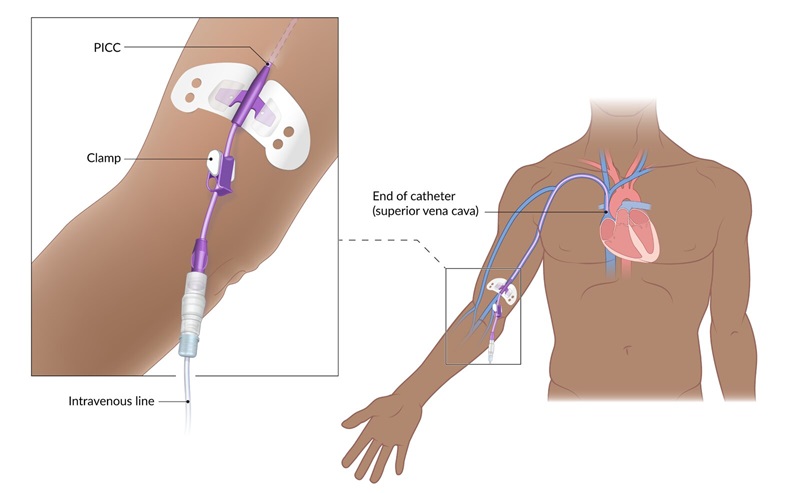 Ilustración de un catéter central de inserción periférica (PICC) mostrando su ubicación desde la entrada en el brazo hasta la punta en la vena cava superior, cerca del corazón