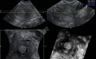 Acuaporinas: Su Papel en la Fisiología y Patología Humana