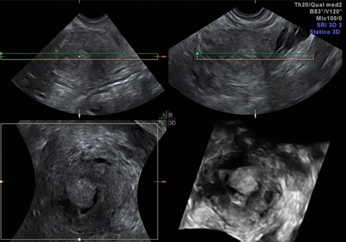 Imagen de ecografía transvaginal tridimensional de útero y endometrio. Se observa un engrosamiento endometrial irregular compatible con un proceso neoplásico. La técnica de imagen en 3D permite una evaluación detallada de la arquitectura y grosor del endometrio, facilitando el diagnóstico y la planificación de intervenciones.