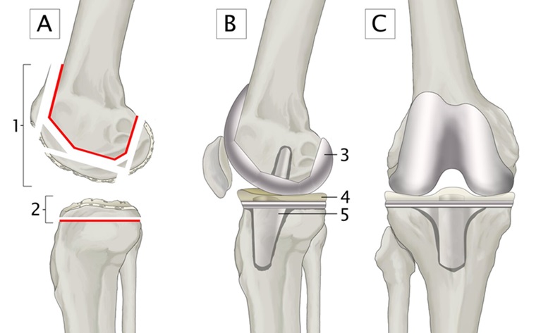 Esquema de los pasos en la artroplastia de rodilla, mostrando el corte de los huesos, la inserción de los componentes protésicos y el resultado final de una articulación de rodilla artificial.