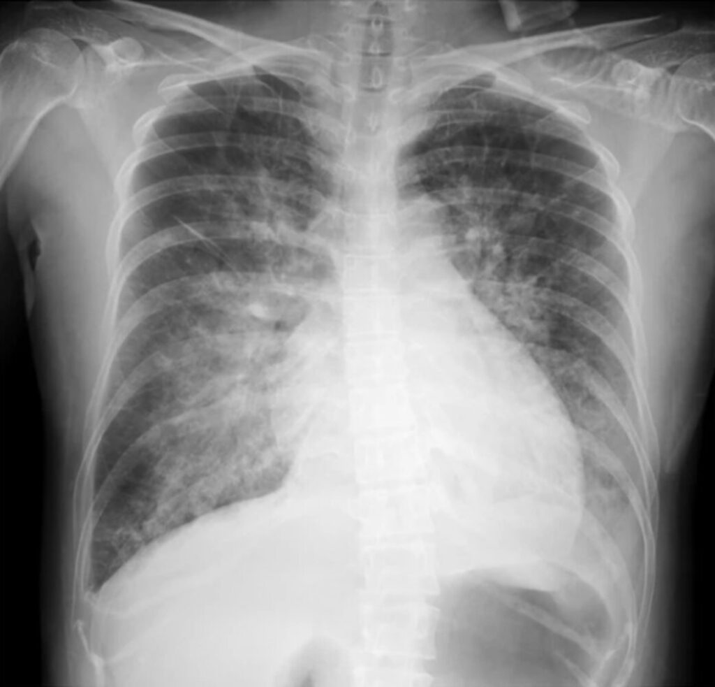 La imagen muestra una radiografía de tórax en vista frontal. Se observa la anatomía torácica, incluyendo las costillas, la columna vertebral y las clavículas.