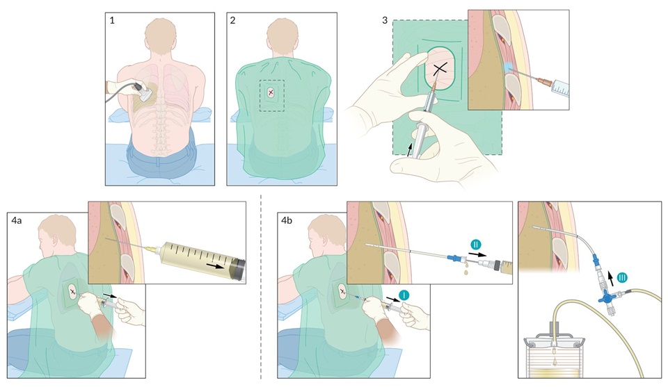 Esta secuencia ilustra la técnica paso a paso de la toracocentesis, desde la preparación y punción hasta la recolección y drenaje del líquido pleural.