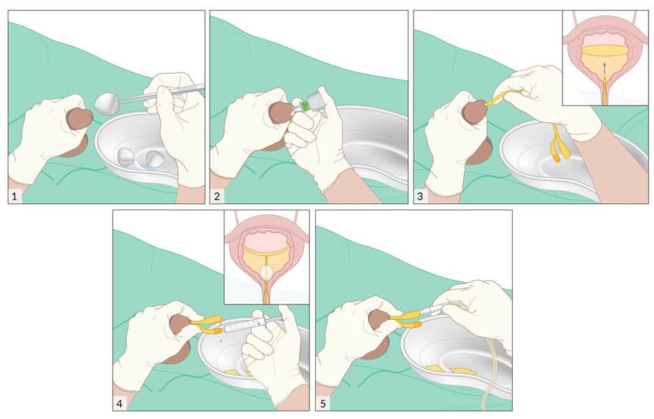 Procedimiento de Colocación de Catéter Urinario en Paciente Masculino