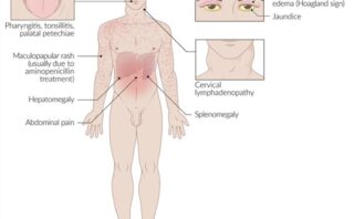 Artritis Reumatoide | CASO CLÍNICO