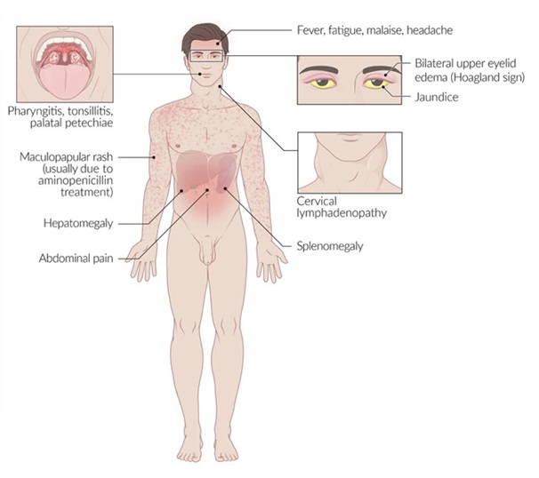 Manifestaciones clínicas de la mononucleosis infecciosa, incluyendo faringitis, linfadenopatías, esplenomegalia, hepatomegalia y exantema maculopapular asociado al uso de aminopenicilinas