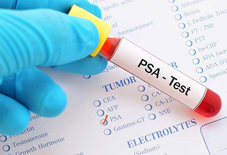 El costo de la prueba de Antígeno Prostático Específico (PSA) en México varía según el laboratorio y la región. Según datos de la Procuraduría Federal del Consumidor (Profeco), los precios pueden oscilar entre $171 y $732 pesos mexicanos