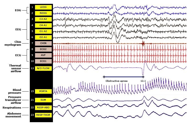 Polisomnografía representativa de apnea obstructiva del sueño severa. Se observan múltiples parámetros simultáneos: movimientos oculares (EOG), actividad cerebral (EEG), actividad muscular submentoniana (chin myelogram), electrocardiograma (ECG), flujo aéreo medido por sensores térmicos y transductores de presión, movimientos torácicos y abdominales. En este ejemplo, se destaca un evento de apnea obstructiva con cese del flujo aéreo (canal 13: N/O FLOW) durante 12.1 segundos, acompañado de esfuerzos respiratorios continuos (canales RESP-ABD y RESP-THOR) y un cambio en el patrón cardiovascular (ECG). El registro evidencia fragmentación del sueño y episodios de hipoxia asociados al evento.