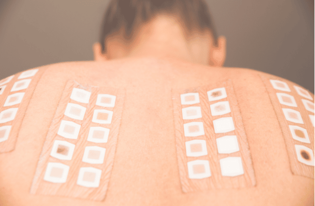 Las pruebas de parche son un método diagnóstico utilizado en dermatología para identificar alergias cutáneas de tipo retardado, es decir, reacciones alérgicas que aparecen horas o días después de la exposición a una sustancia. Estas pruebas son especialmente útiles para detectar dermatitis de contacto alérgica, una condición en la que la piel reacciona ante el contacto con alérgenos específicos.