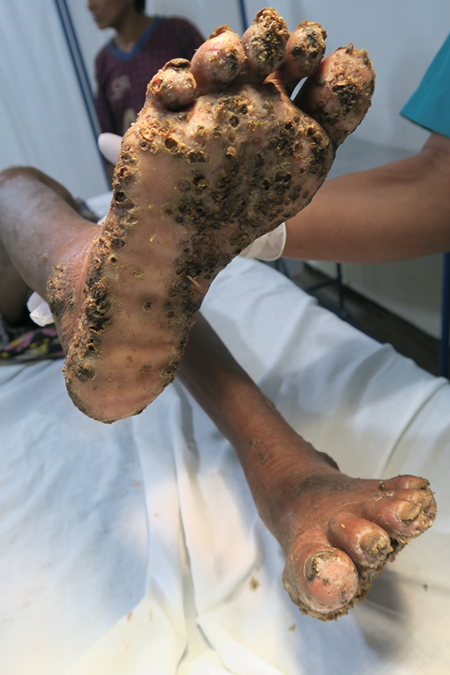 Caso severo de tungiasis, con múltiples lesiones hiperqueratósicas y costrosas en la planta del pie y los dedos. La infestación por Tunga penetrans ha generado inflamación, úlceras y formación de nódulos, evidenciando una carga parasitaria extrema y riesgo de sobreinfección bacteriana.