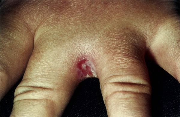 Lesión eritematosa y macerada en el pliegue interdigital de la mano, característica de candidiasis intertriginosa (intertrigo por Candida). Se observa inflamación, fisuración y áreas blanquecinas, signos típicos de infección por Candida spp., frecuente en condiciones de humedad y fricción.