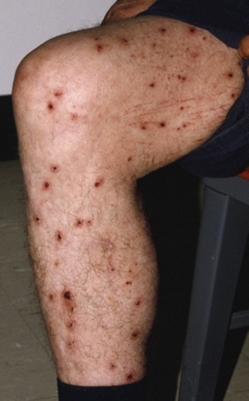 Lesiones cutáneas múltiples en extremidad inferior causadas por Pediculosis corporis. Se observan pápulas eritematosas, excoriaciones y costras secundarias al rascado intenso, características de la infestación por Pediculus humanus corporis.