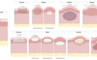 Lesiones Secundarias en Dermatología