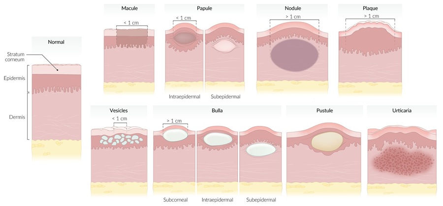 Clasificación de las lesiones primarias en dermatología. Se muestran diferentes tipos de lesiones cutáneas primarias, incluyendo máculas, pápulas, nódulos, placas, vesículas, ampollas (bulla), pústulas y habones (urticaria). La ilustración destaca su ubicación en las distintas capas de la piel: epidermis, dermis e hipodermis.