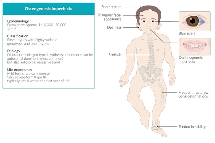 Ilustración representativa de un paciente con osteogénesis imperfecta, mostrando las principales manifestaciones clínicas de la enfermedad. Se observan escleróticas azuladas, dentinogénesis imperfecta, talla baja, deformidades óseas, escoliosis y fracturas frecuentes. También se destacan rasgos faciales característicos como la apariencia triangular del rostro y la posibilidad de hipoacusia. La imagen resume aspectos clave de la epidemiología, clasificación, etiología y esperanza de vida de los pacientes con esta condición genética.