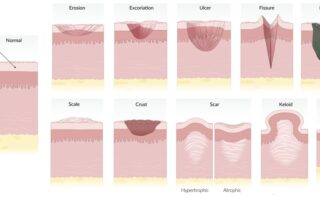 Lesiones Primarias en Dermatología