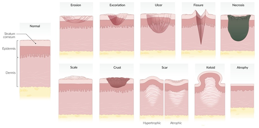 Clasificación de las lesiones secundarias en dermatología. La ilustración muestra distintos tipos de lesiones secundarias de la piel, incluyendo erosión, excoriación, úlcera, fisura y necrosis, así como manifestaciones de reparación y alteraciones estructurales como escama, costra, cicatriz (hipertrófica y atrófica), queloide y atrofia. Se destaca su localización en las diferentes capas de la piel: epidermis, dermis y estrato córneo.