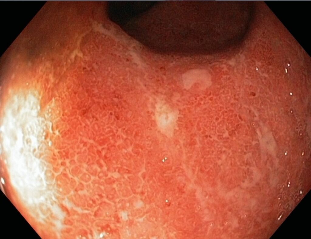 Imagen endoscópica de colitis ulcerativa: Inflamación severa de la mucosa intestinal con ulceraciones y eritema, característicos de la enfermedad inflamatoria intestinal. Tratamiento incluye aminosalicilatos, corticosteroides e inmunomoduladores según la severidad del caso